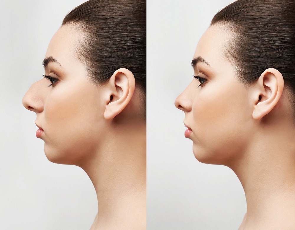 Prosthesis For The Nose Tip: The Surgical Way