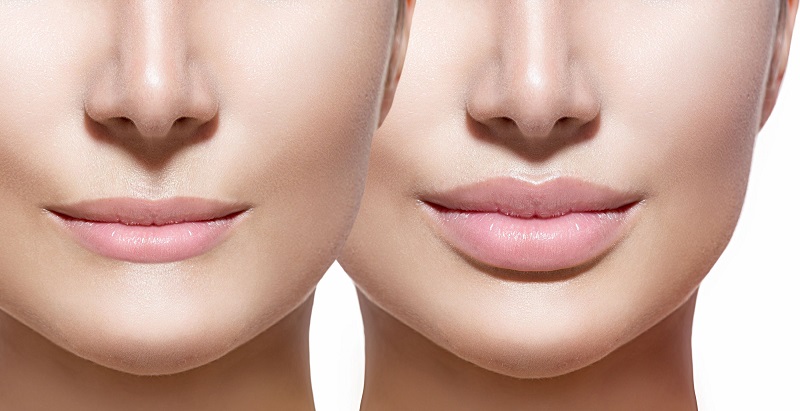Make Your Lips More Beautiful Through Filler Injections